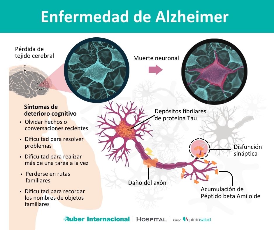 Enfermedad De Alzheimer